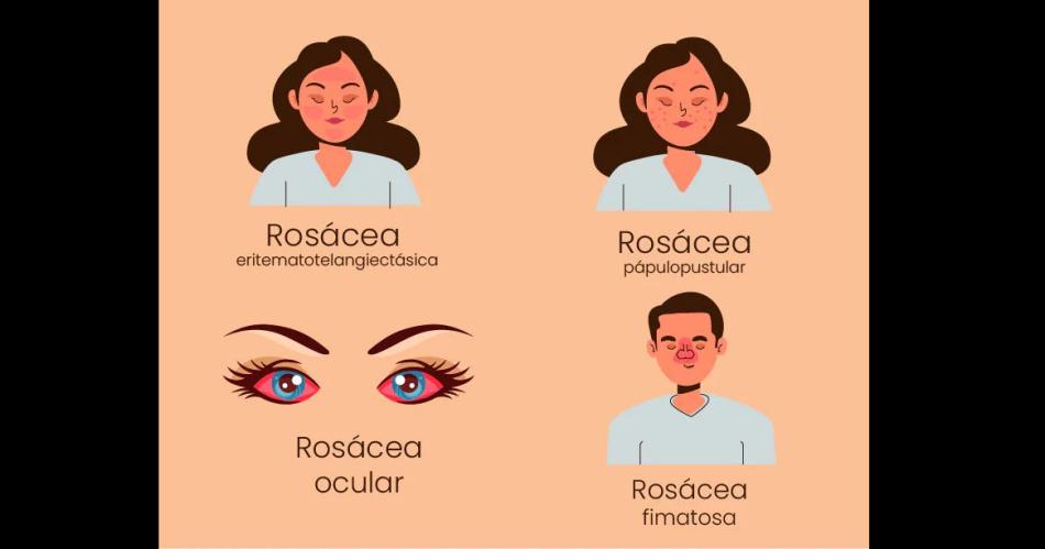 Rosaacutecea- afeccioacuten cutaacutenea que requiere de un diagnoacutestico preciso para un tratamiento eficaz