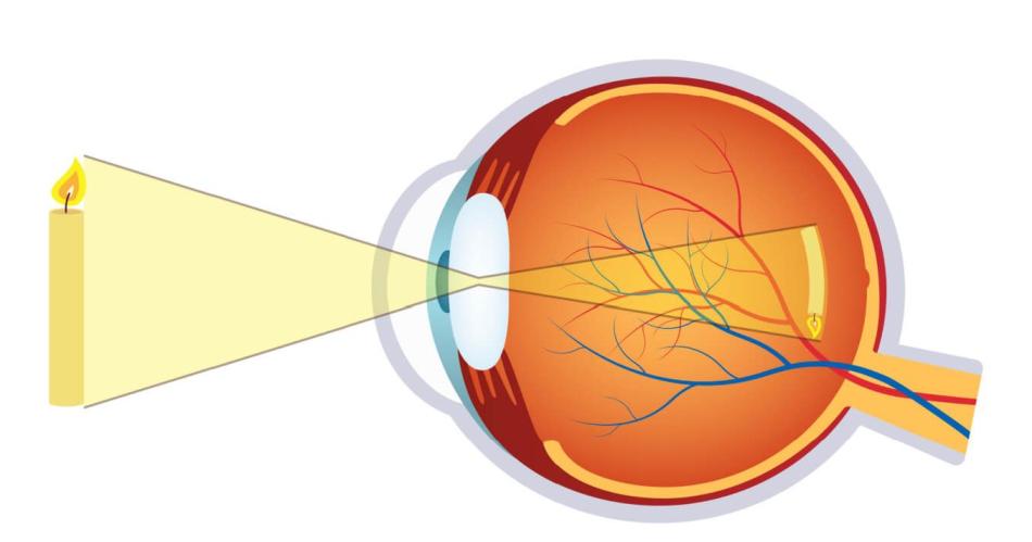 Miopiacutea una afeccioacuten que crece iquestQueacute podemos hacer para evitarla
