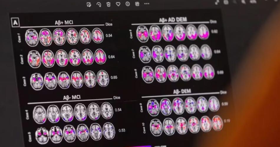 La FDA aprobó el frmaco donanemab contra el Alzheimer (REUTERS)