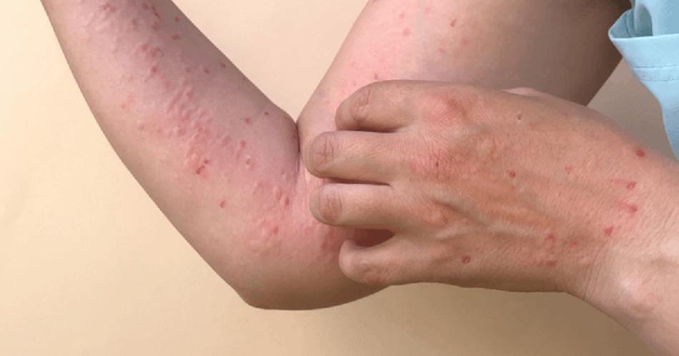 En Argentina hay cinco casos confirmados de viruela del mono en lo que va del 2024