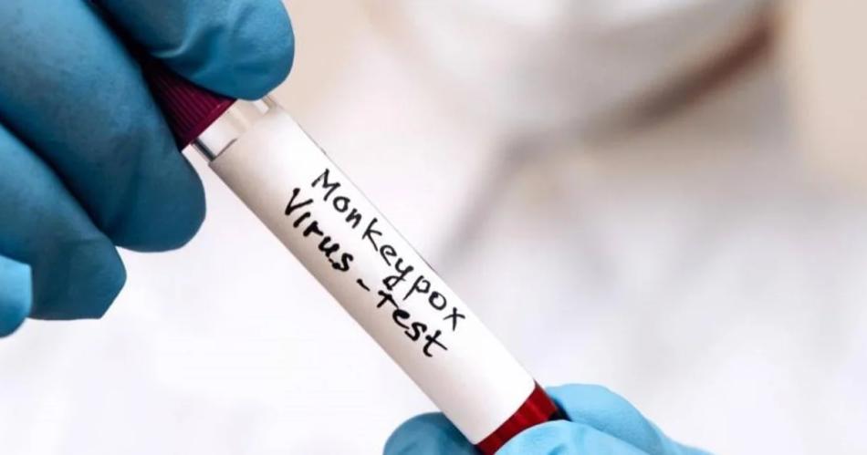 URGENTE Confirman el primer caso autoacutectono de viruela del mono en Argentina