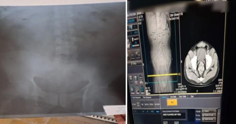 Interceptan en tour de compras a dos bolivianos con 200 caacutepsulas de cocaiacutena en el estoacutemago