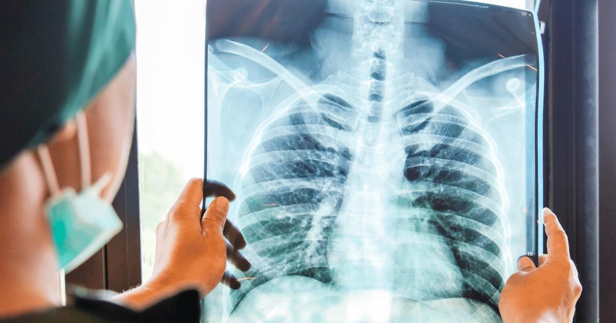 Registran 12 mil nuevos casos de caacutencer de pulmoacuten cada antildeo