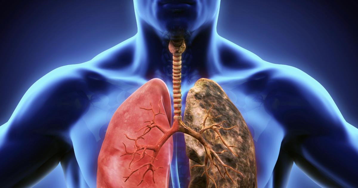 Es uno de los caacutenceres maacutes comunes a nivel mundial