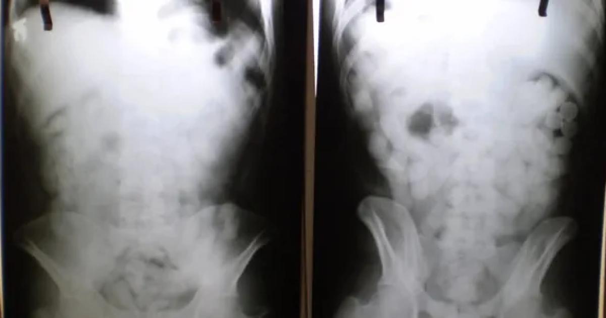 Cayoacute una mula que llegaba de Peruacute y teniacutea 90 caacutepsulas de cocaiacutena en el cuerpo