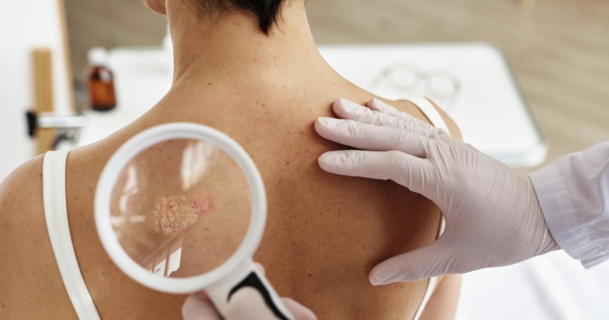 El caacutencer de piel es uno de los caacutenceres que mejor pronoacutestico tiene con un 95-en-porciento- de curacioacuten