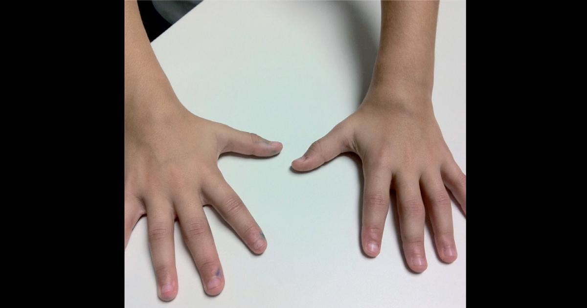 Alerta- por el frío piden reforzar los cuidados a los pacientes que padecen artritis reumatoidea