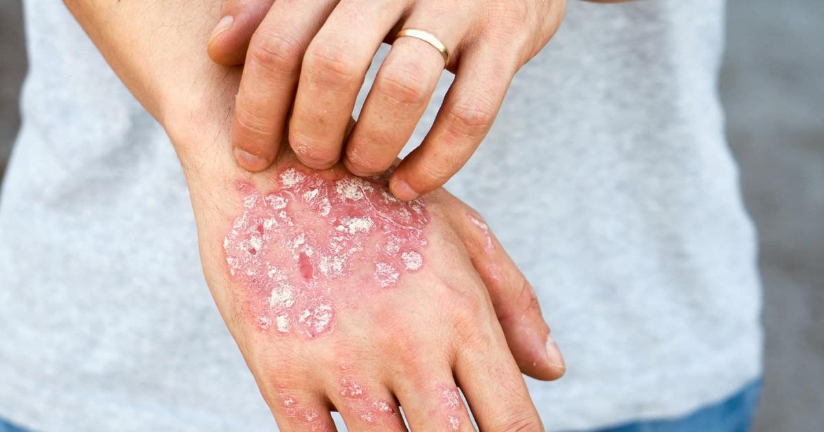 Psoriasis- un diagnoacutestico temprano puede cambiar la historia de quienes tienen siacutentomas