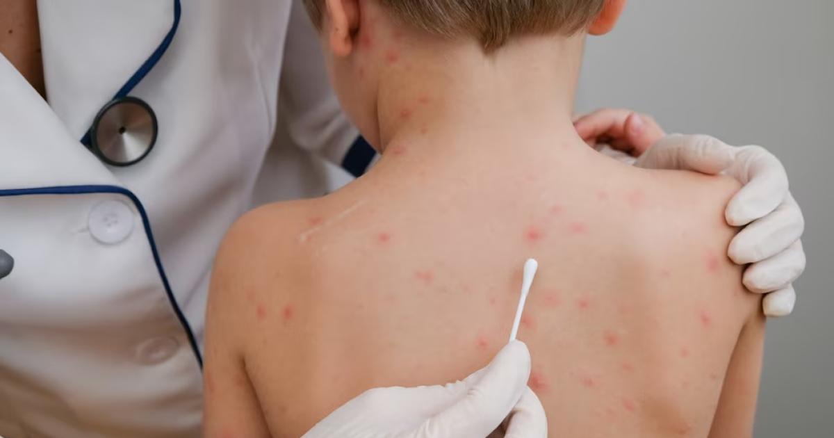 Sarampioacuten en Argentina- coacutemo se explica su reaparicioacuten y queacute respuestas se necesitan