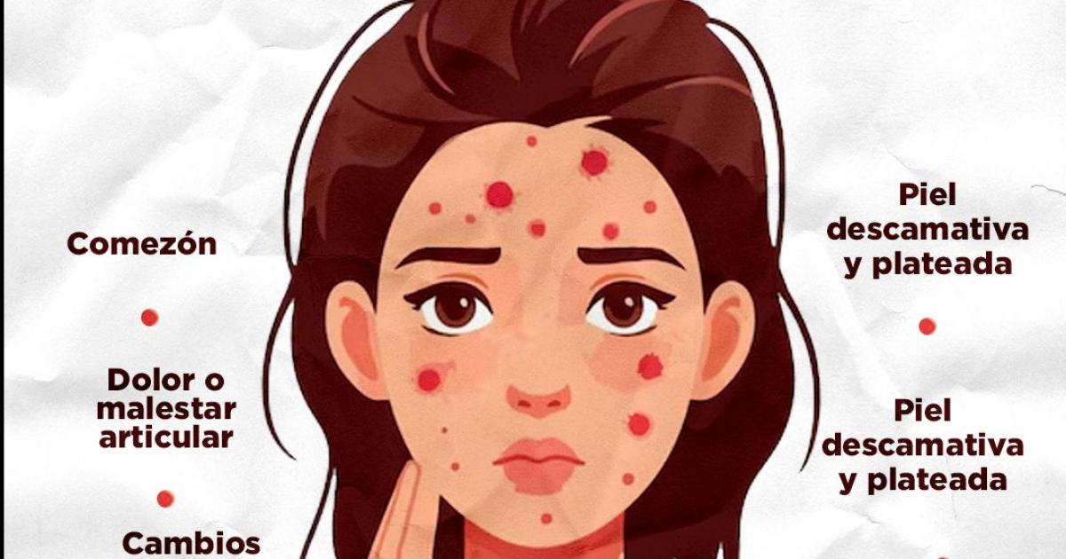 Psoriasis- un diagnoacutestico temprano puede cambiar la historia de quienes tienen siacutentomas