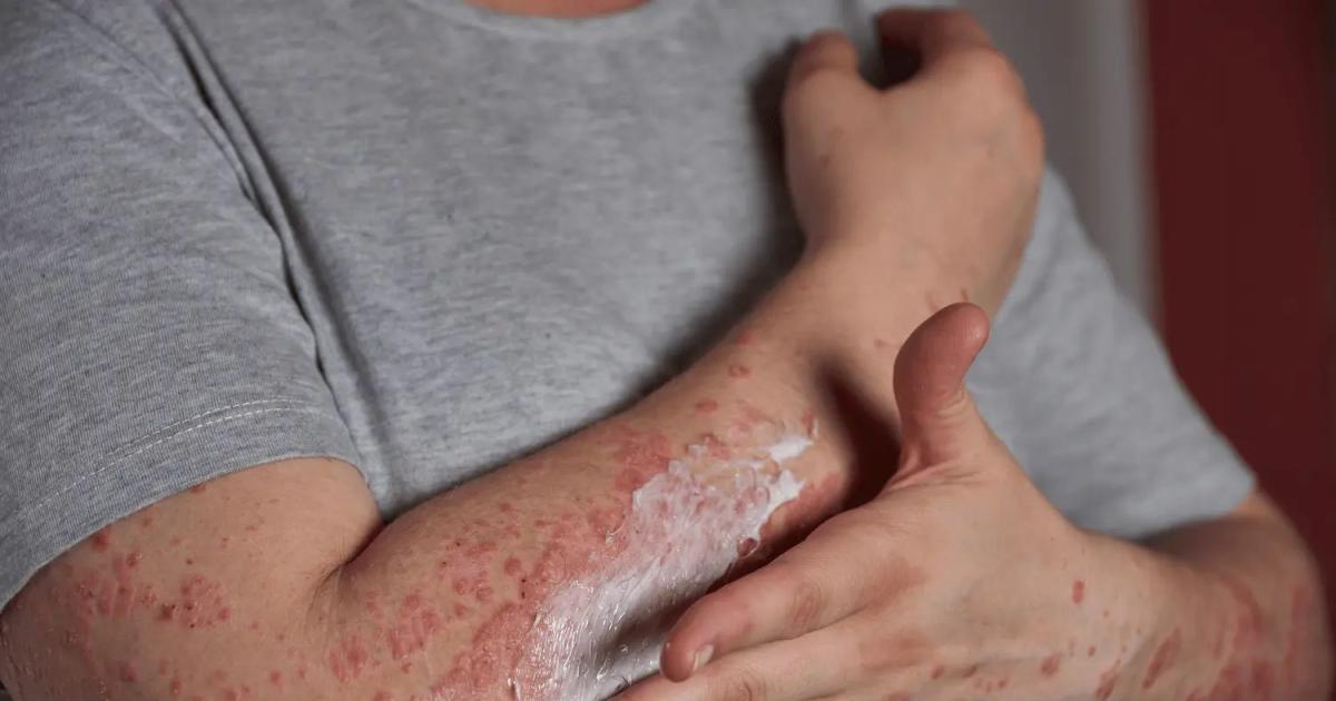 Psoriasis- un diagnoacutestico temprano puede cambiar la historia de quienes tienen siacutentomas