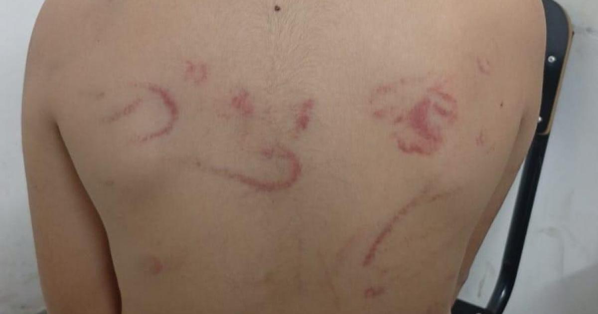 GRAVÍSIMO El pequeño tenía tatuada en la espalda las palizas que recibía por parte de la incalificable mujer