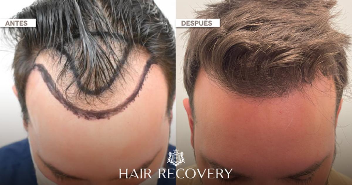 Hair Recovery lanza exclusivo diagnoacutestico capilar con Inteligencia Artificial