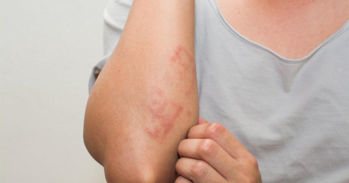 AFECCIÓN Es una condición inflamatoria e inmunológica compleja que afecta la vida en mltiples planos