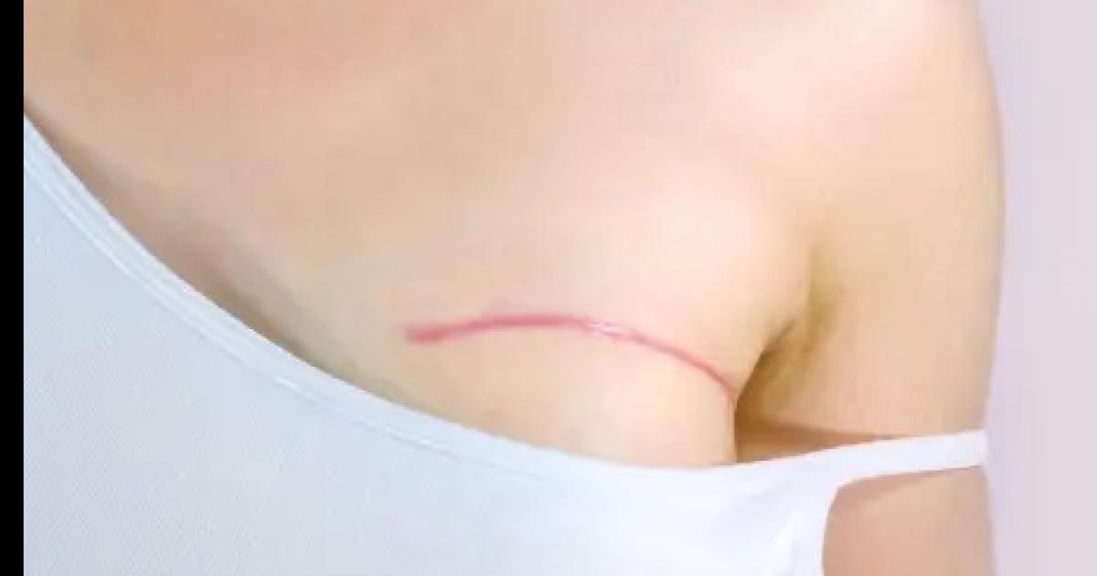 El lunes lanzaraacuten el proyecto Cicatrices que Salvan Vidas