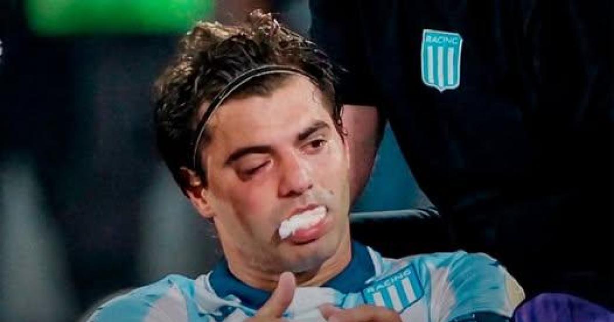 Operaraacuten a Sosa de la fractura en el maxilar