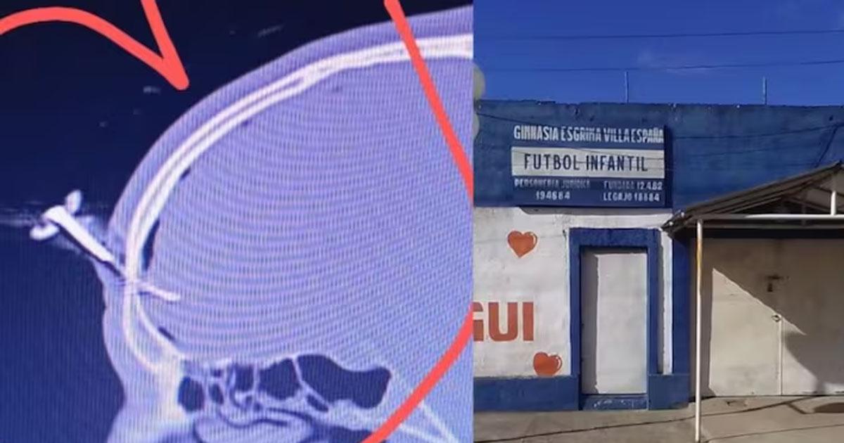 Batalla campal en un partido de fuacutetbol- un hombre fue apuntildealado en el craacuteneo