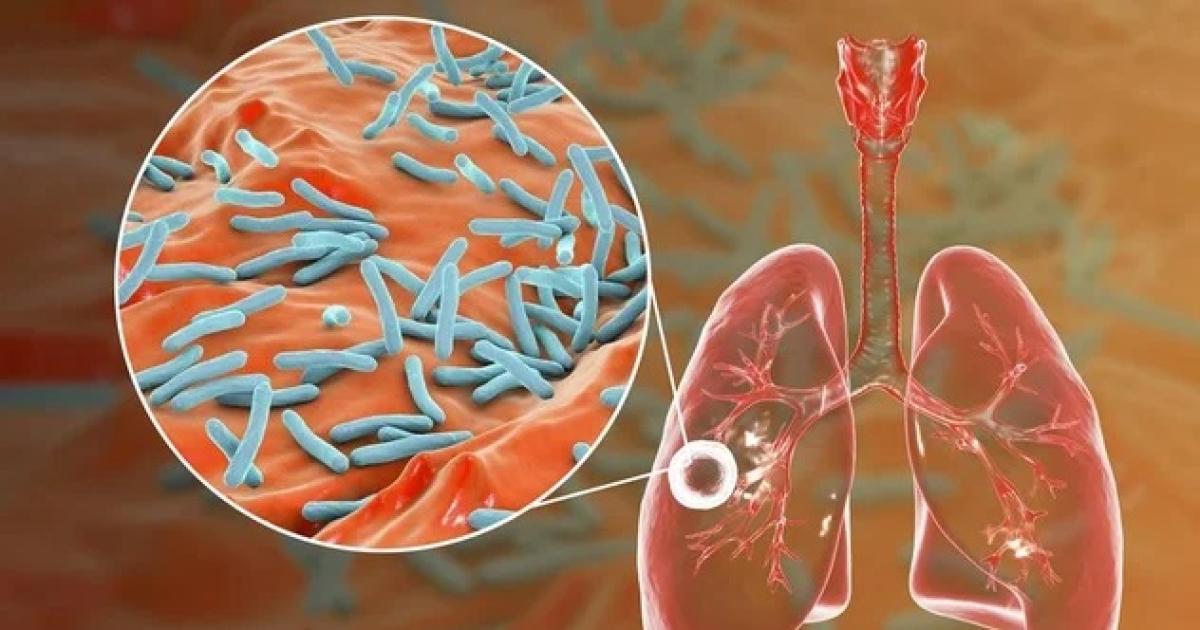 Alerta tuberculosis- se notificaron maacutes de 13000 casos en el paiacutes