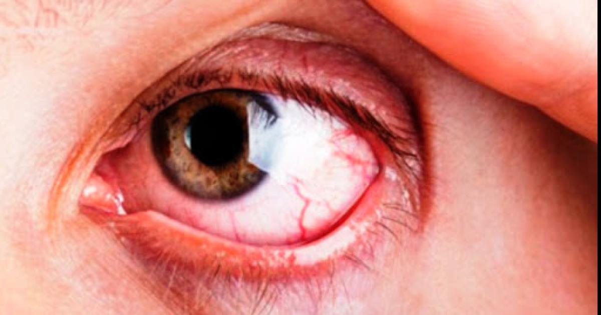 Las 4 enfermedades oculares frecuentes en la vejez- claves para detectarlas