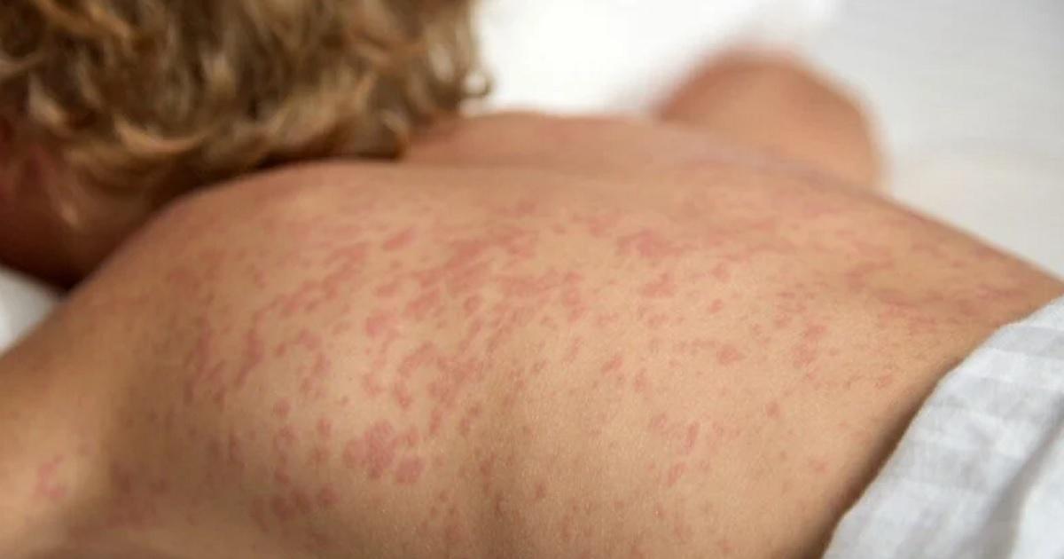 Entre Riacuteos- se reactiva la alerta nacional por el aumento de casos con sarampioacuten