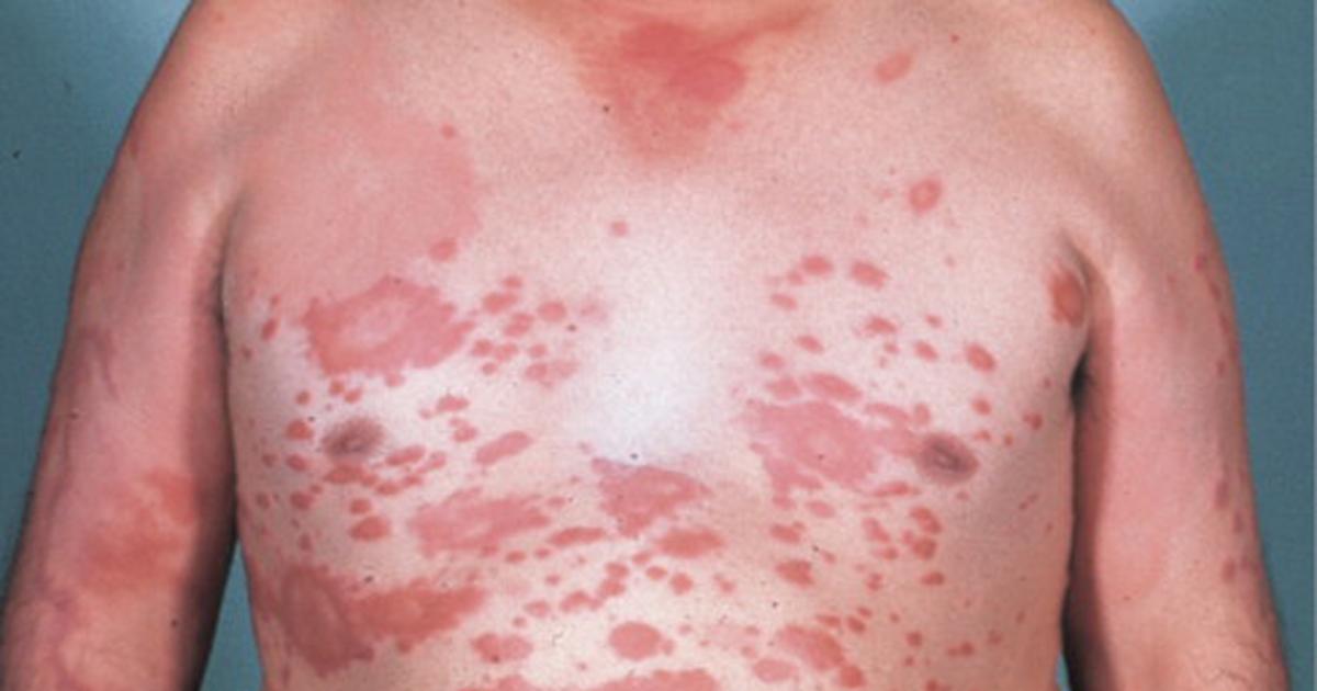 BUENA NOTICIA La lepra sí se cura Cuanto ms precoz el diagnóstico mejor es el pronóstico remarcó Llapur