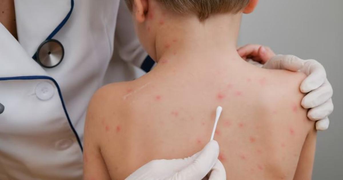 El operativo sanitario vigente monitorea a 98 contactos estrechos vinculados al brote importado de sarampión en Argentina