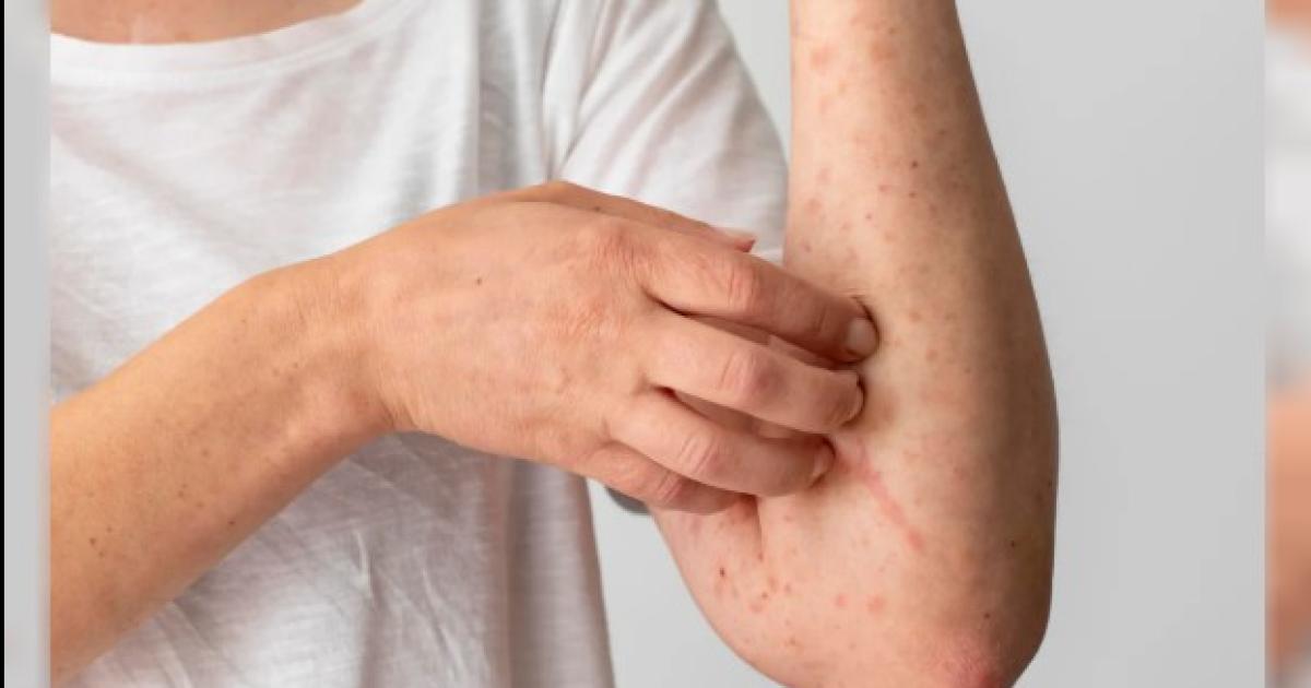 Un brote de sarampión en Carolina del Sur Foto- Agencia NA (Freepik)