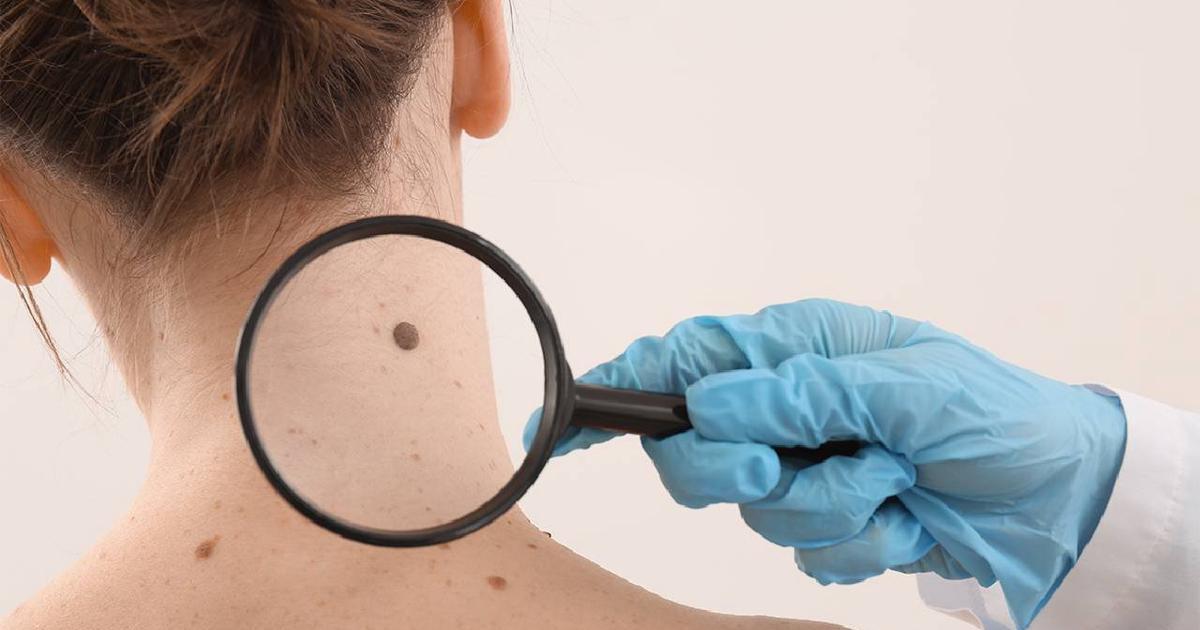 Coacutemo proteger la piel en el verano durante el tratamiento oncoloacutegico