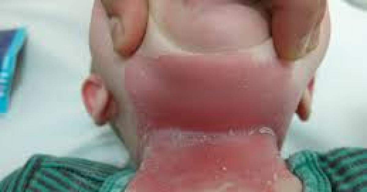 Atencioacuten papaacutes- la humedad puede generar quemaduras en la piel de los maacutes pequentildeos