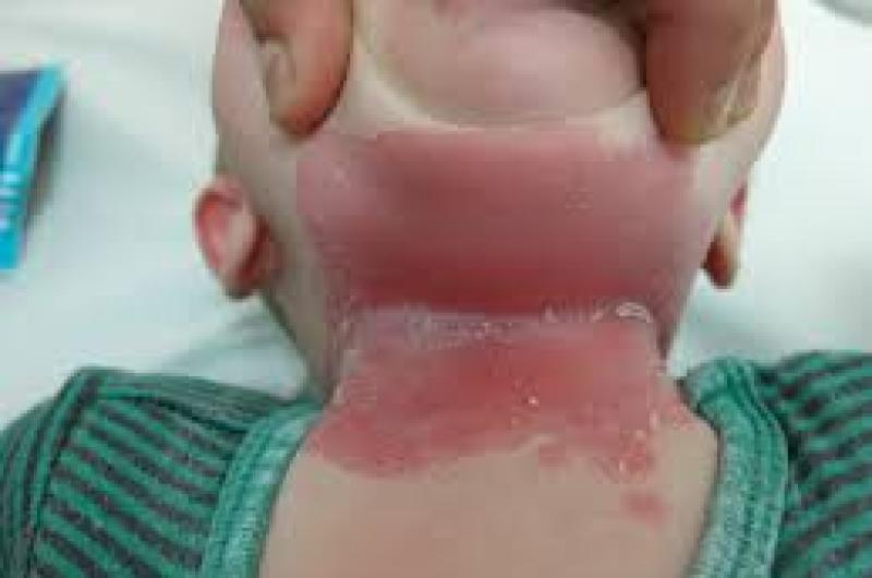 Atencioacuten papaacutes- la humedad puede generar quemaduras en la piel de los maacutes pequentildeos