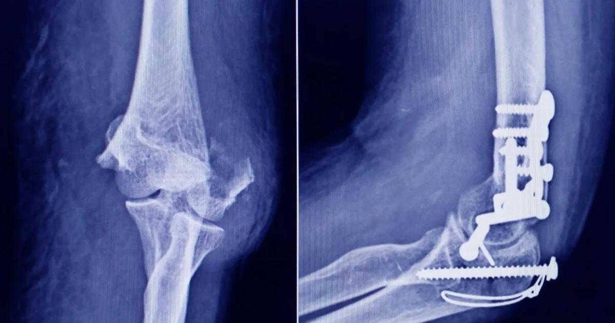 La Anmat advierte que tornillo de uso traumatoloacutegico es falso