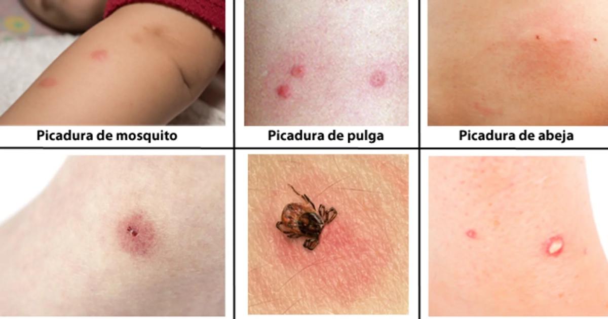 Brindan informacioacuten sobre coacutemo identificar picaduras de insectos