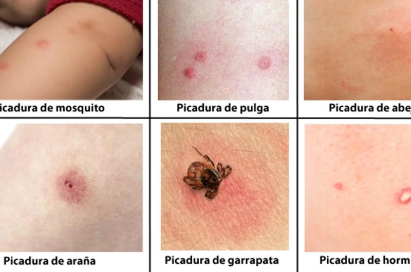 Brindan informacioacuten sobre coacutemo identificar picaduras de insectos