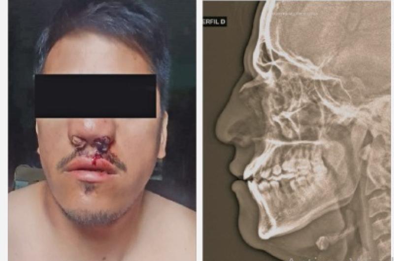 CONTRACARA Gómez perdió mucha sangre y la placa refleja las secuelas del golpe