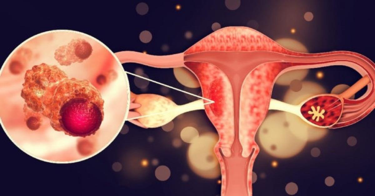 PREOCUPANTE Es la causa principal del c�ncer de cuello de �tero