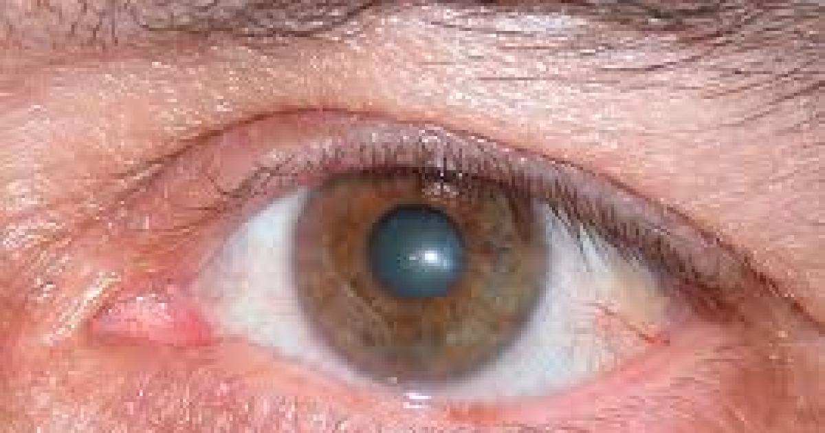 El viernes 13 realizaraacute una campantildea gratuita de prevencioacuten de deteccioacuten de glaucoma 