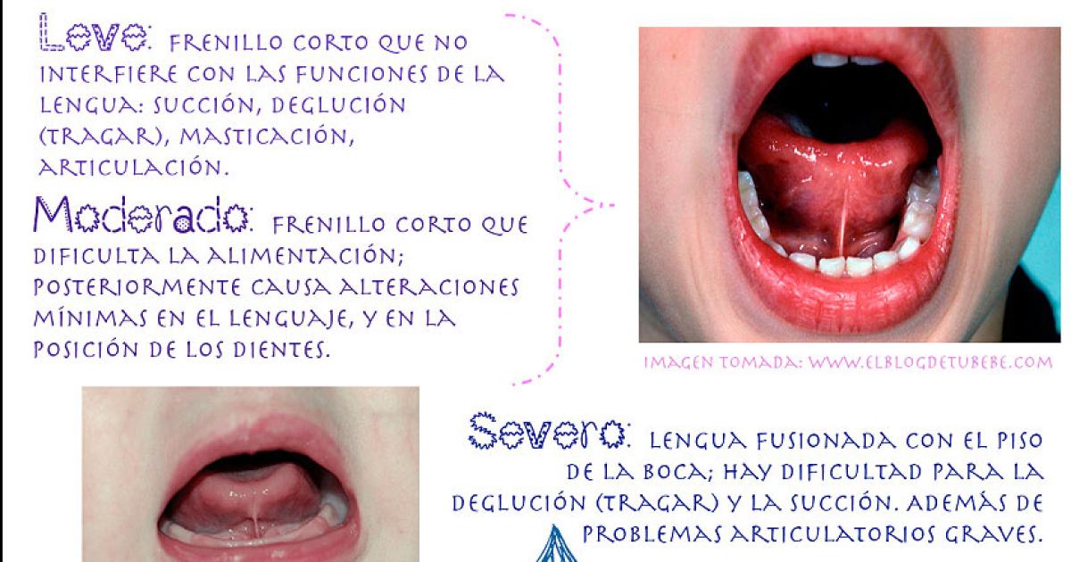 CASOS El diagnóstico no debe basarse �nicamente en la apariencia del frenillo sino en el impacto que genera en la función