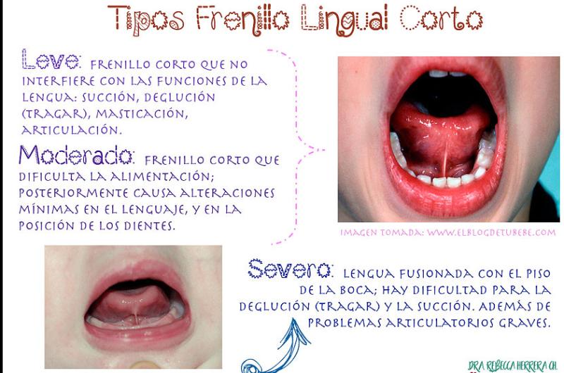 CASOS El diagnóstico no debe basarse �nicamente en la apariencia del frenillo sino en el impacto que genera en la función