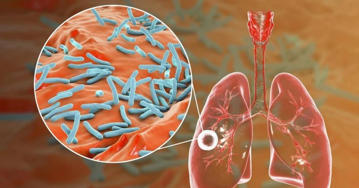Diacutea Mundial de la Tuberculosis- actualizan pautas para su abordaje 