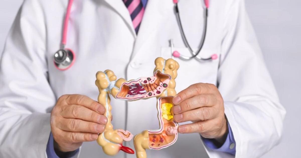 Caacutencer de colon- nuevas terapias cambian pronoacutestico