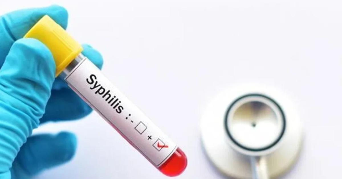 Alerta por siacutefilis- seguacuten el Boletiacuten Epidemioloacutegico Nacional en 2025 hubo maacutes de 46000 casos