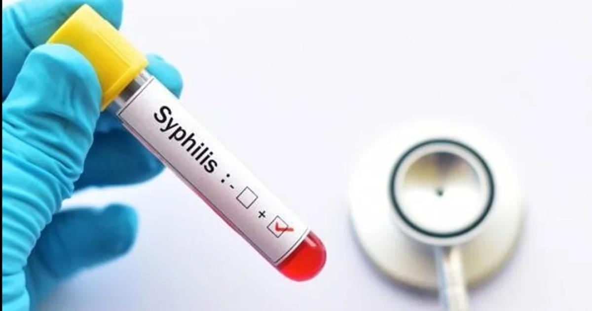Alerta siacutefilis- en 2025 hubo maacutes de 46000 casos confirmados