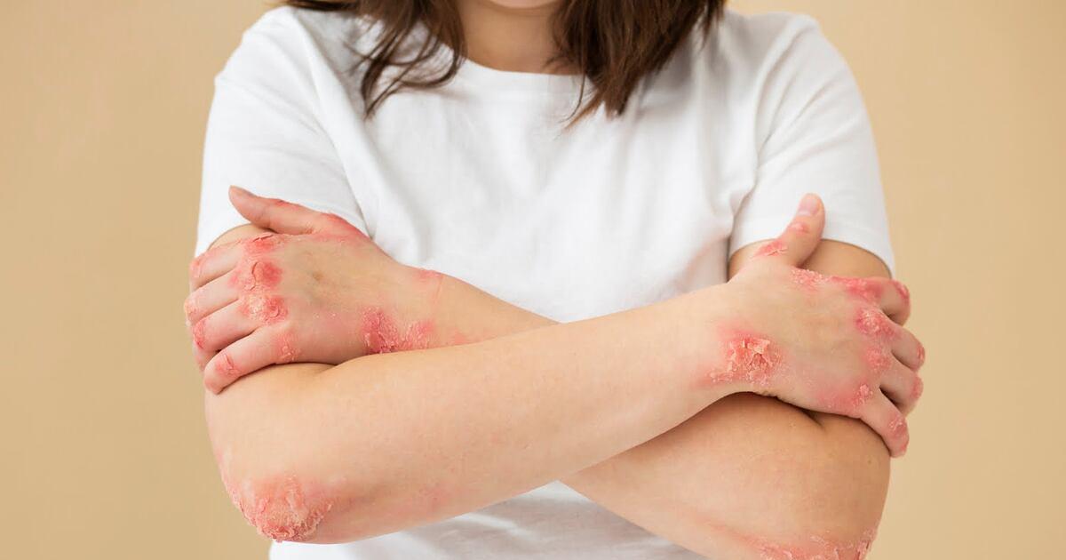 Lanzaron una campantildea de deteccioacuten gratuita de la dermatitis atoacutepica