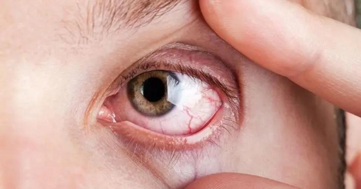 Rascarse los ojos- iquestcuaacuteles son sus riesgos para la salud ocular