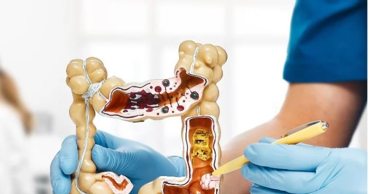 Caacutencer colorrectal- el desafiacuteo para la deteccioacuten temprana 