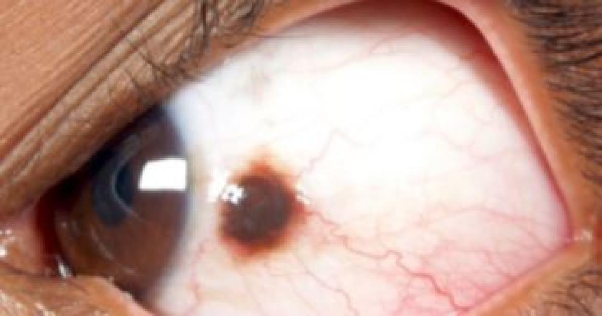 Lunares en el ojo fenoacutemeno que recomiendan que debe ser vigilado