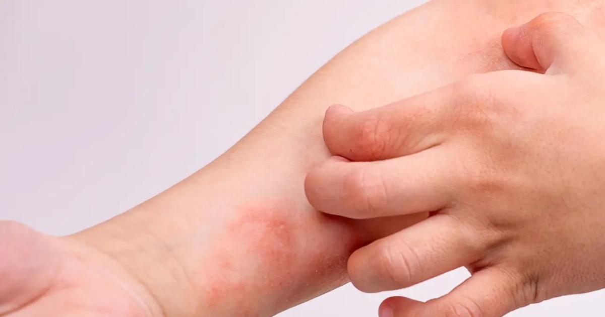 La dermatitis atoacutepica en la infancia puede anticipar asma y otras enfermedades aleacutergicas