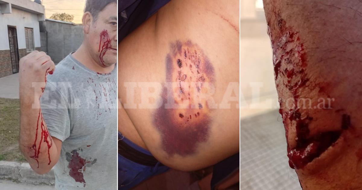 Brutal ataque en el Bordm Borges- dos pitbulls se abalanzaron sobre un hombre y lo dejaron cubierto de sangre