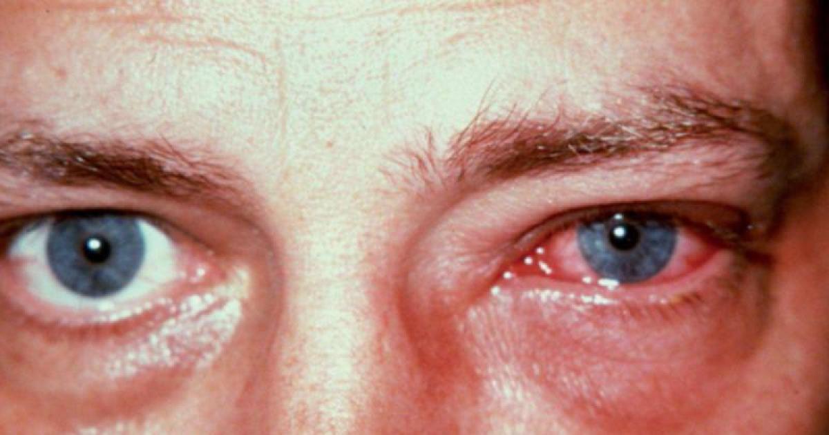 Primavera- comienza la eacutepoca de clima agradable pero tambieacuten de alergias oculares