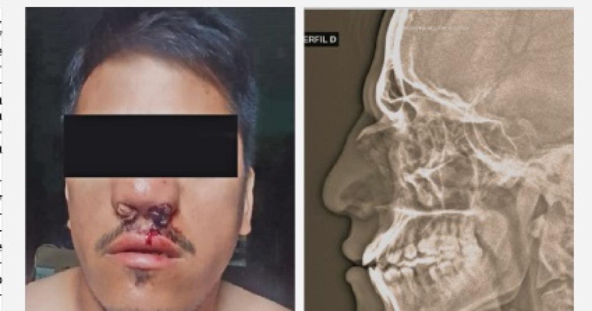 Piden elevar a juicio a futbolista que causoacute fracturas a un aacuterbitro
